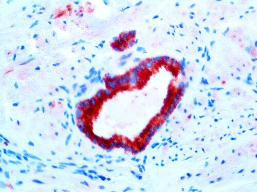 IHC of AMACR on a FFPE Prostatoc Adenocarcinoma Tissue